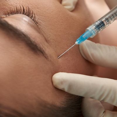 crows feet procedure