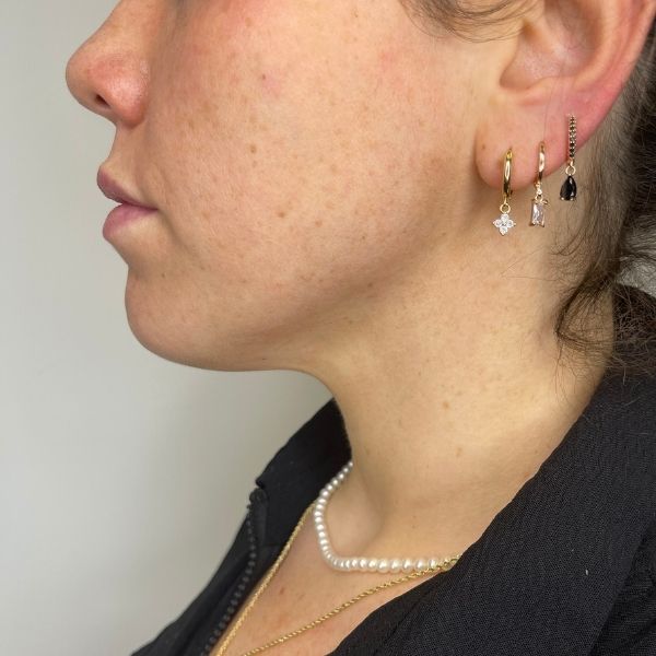 jawline slimming 1a