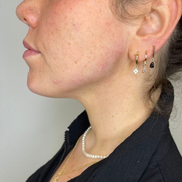 jawline slimming 1b