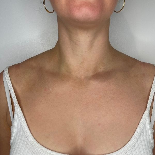 neck & platysmal bands 2a