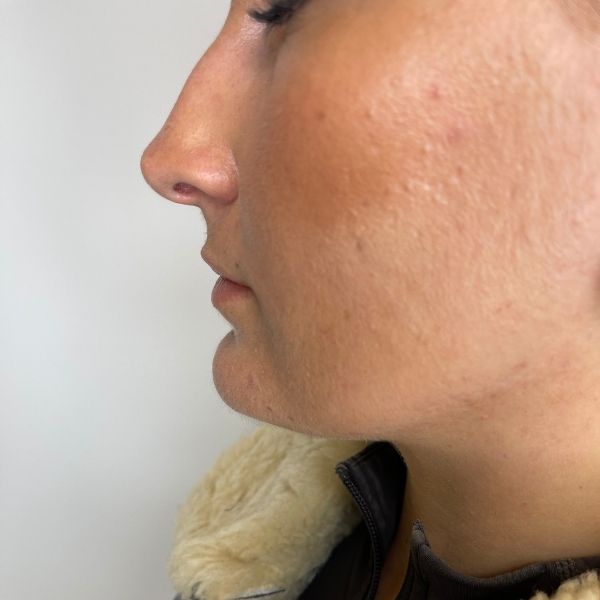 non surgical rhinoplasty 3a