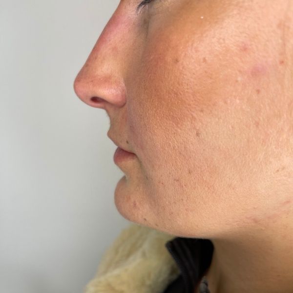 non surgical rhinoplasty 3b