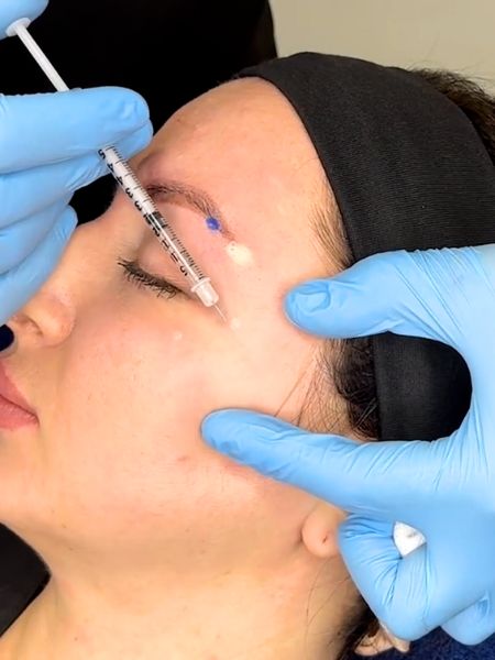 Crows Feet Periorbital Botox Training
