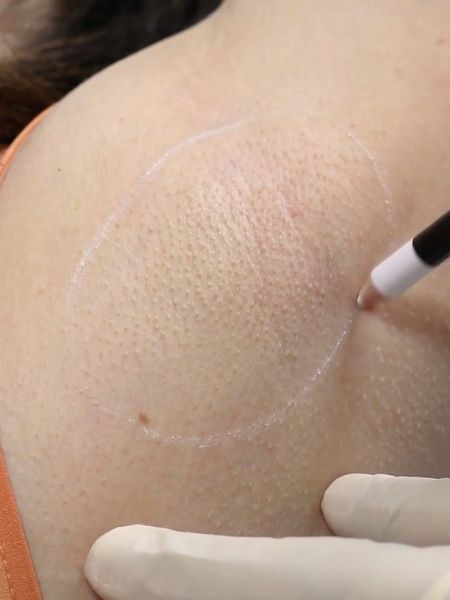 Excessive Sweating Hyperhidrosis Botox Training