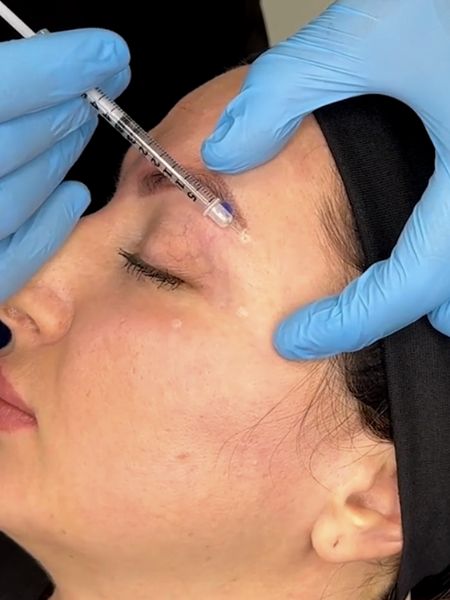 Botox Brow Lift Training