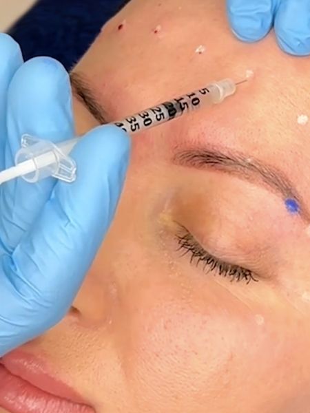 Frontalis Botox Training