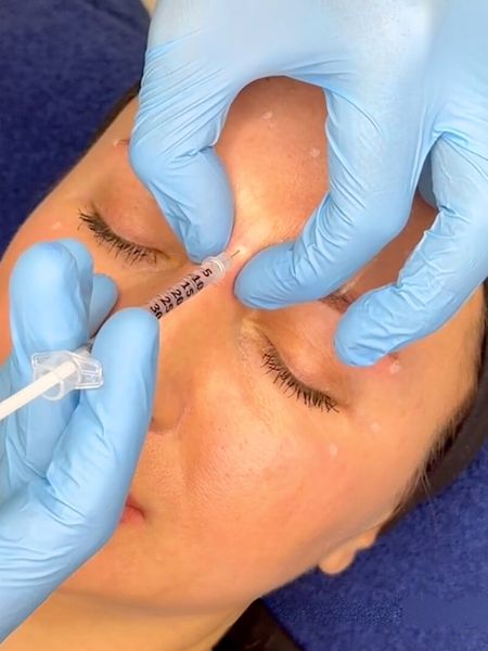 Frown Lines Botox Training