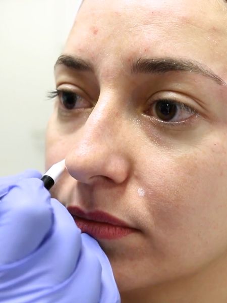 Gummy Smile Botox Training