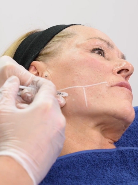 Jawline Slimming Botox