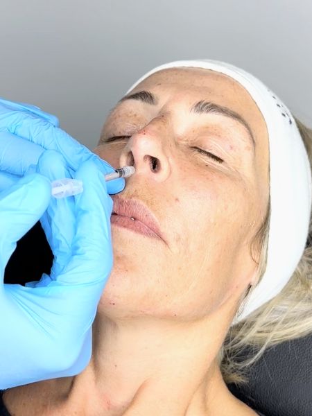 Nose Tip Lift Botox Training