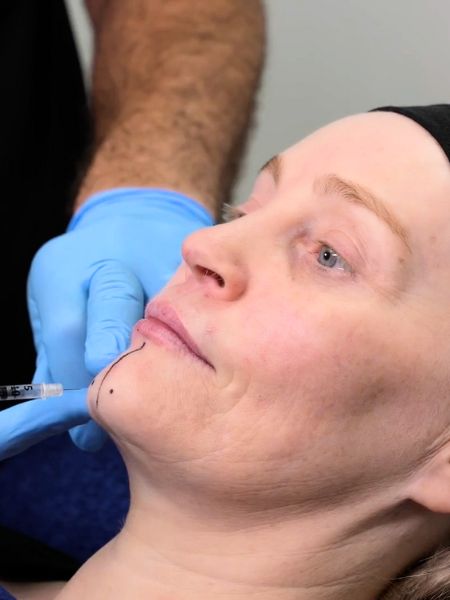 Pebbled Dimpled Chin Botox Training