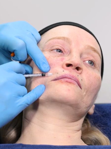 Smokers Lines Botox Training
