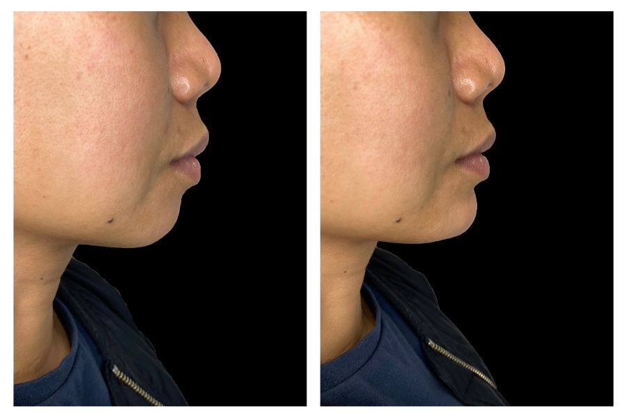 Chin Augmentation filler