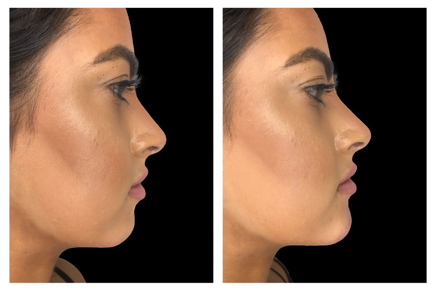 Chin Augmentation filler