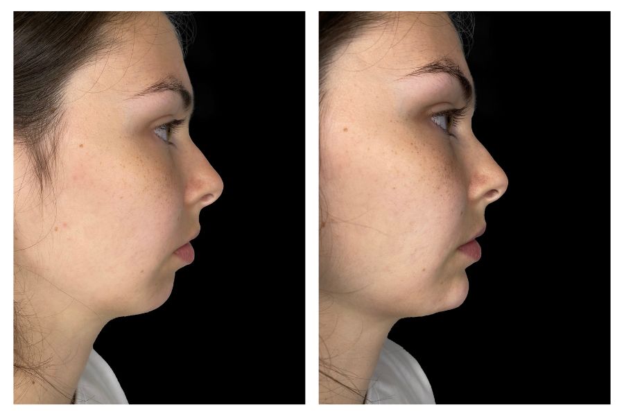 Chin Augmentation filler