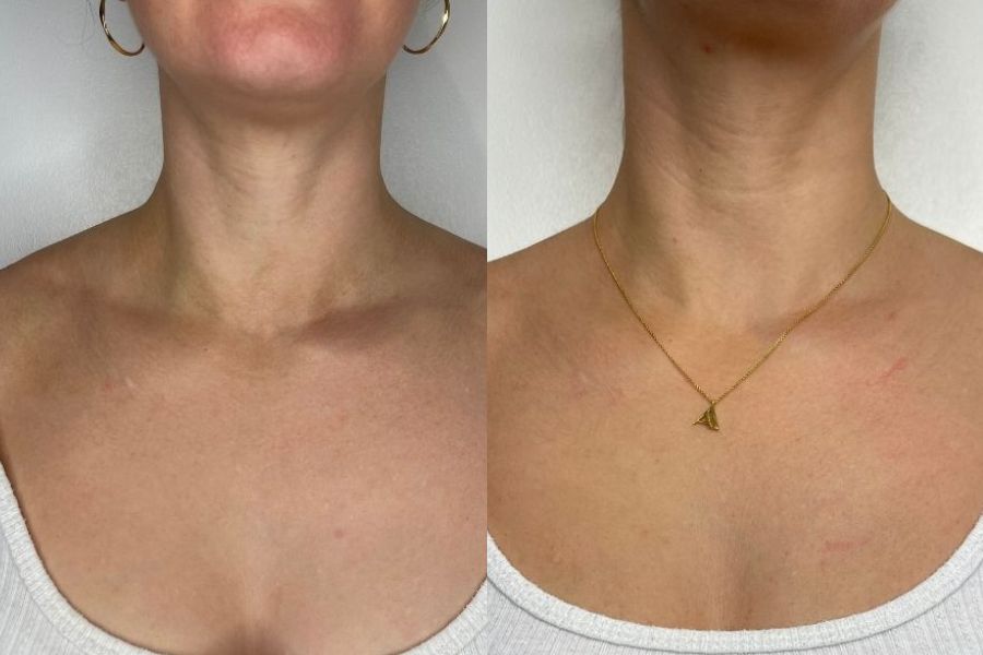 botox models before and after