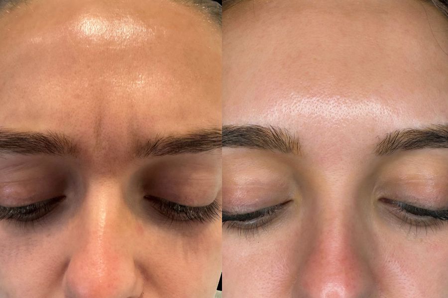 botox models before and after
