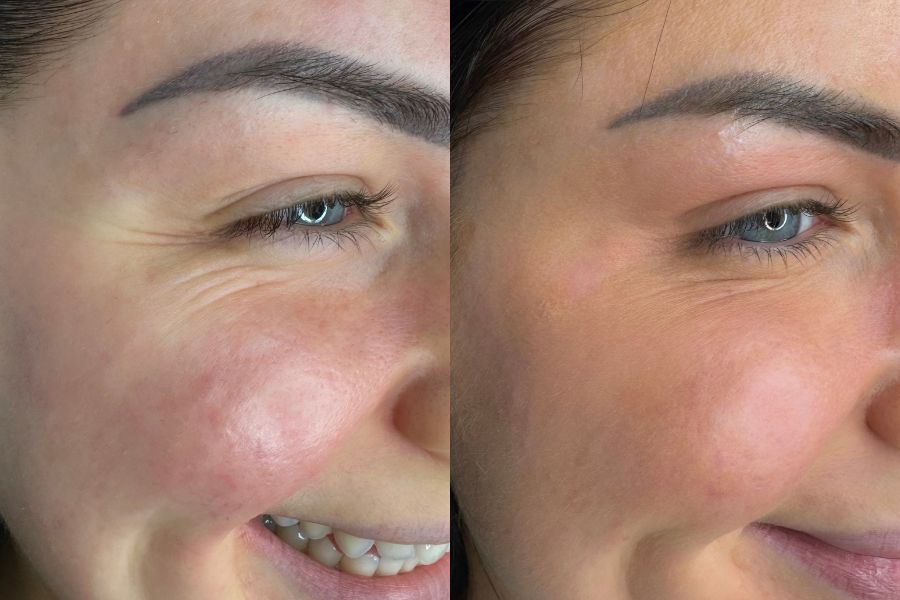 cheek filler before and after
