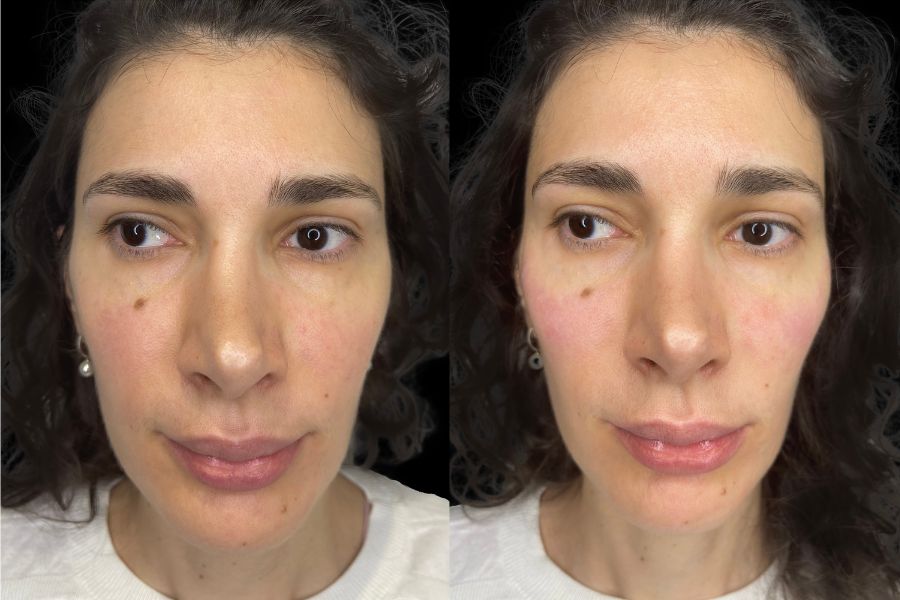 cheek filler before and after