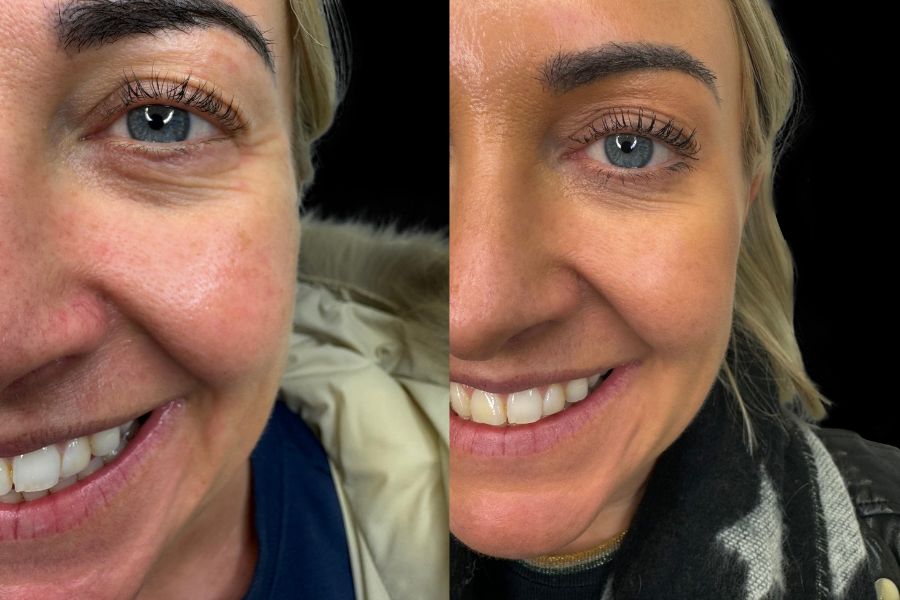 cheek filler before and after