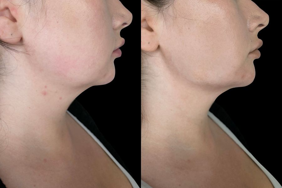 jawline filler before and after