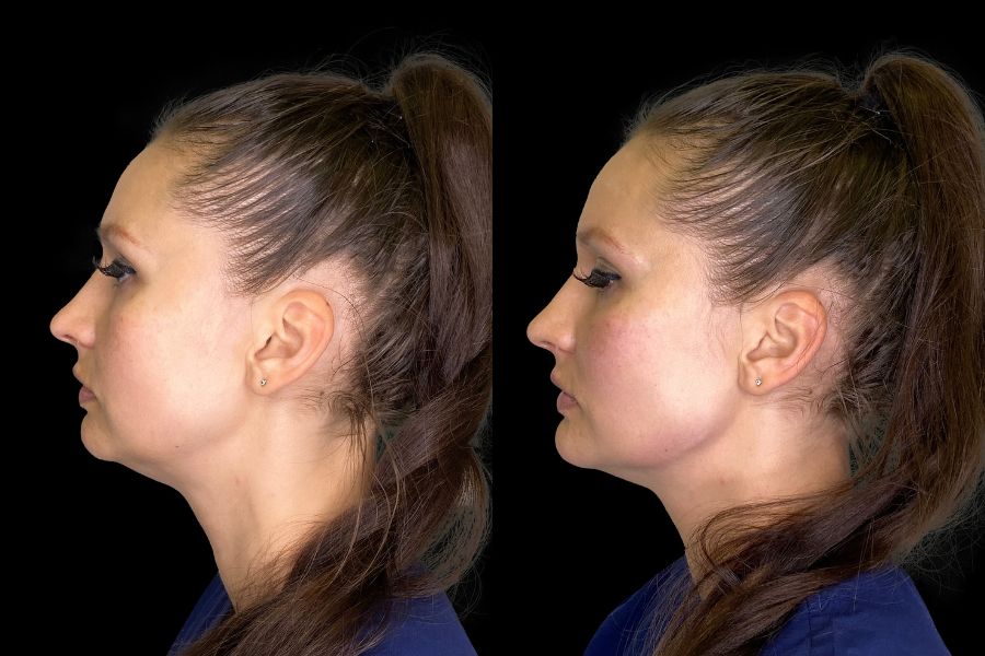 jawline filler before and after