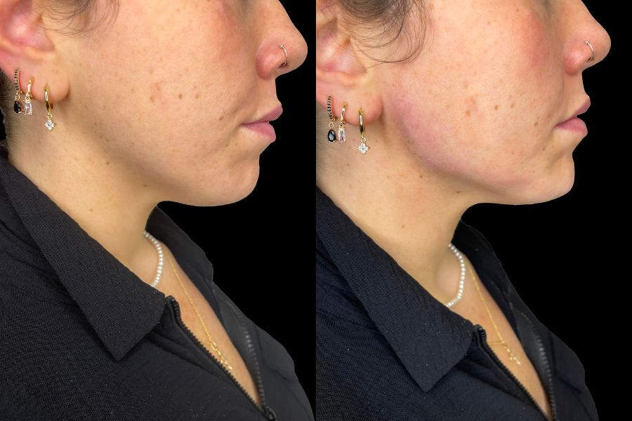 jawline filler before and after
