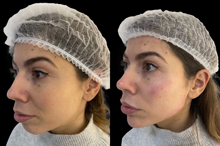 jawline filler before and after