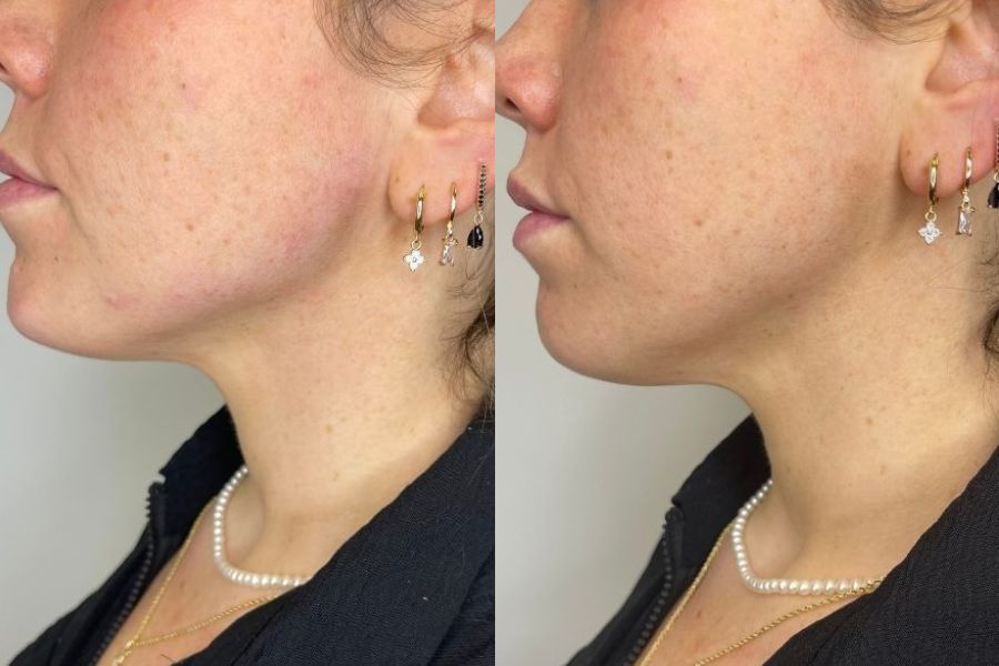 jawline slimming before and after