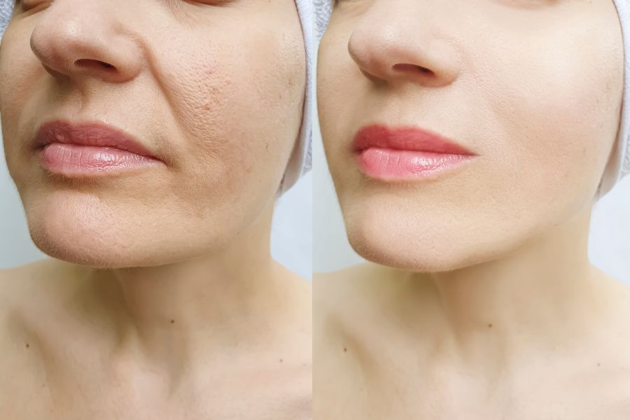 jawline slimming before and after