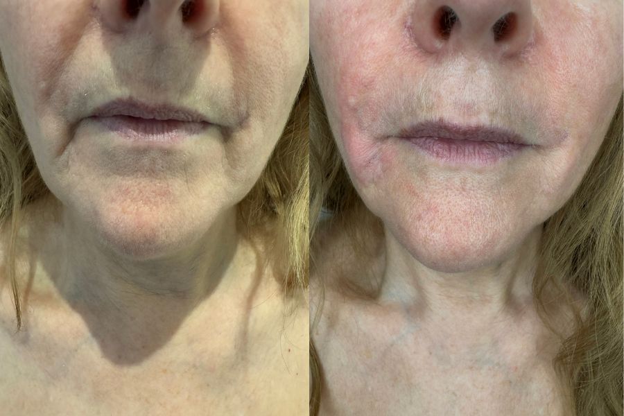 marionette line filler before and after