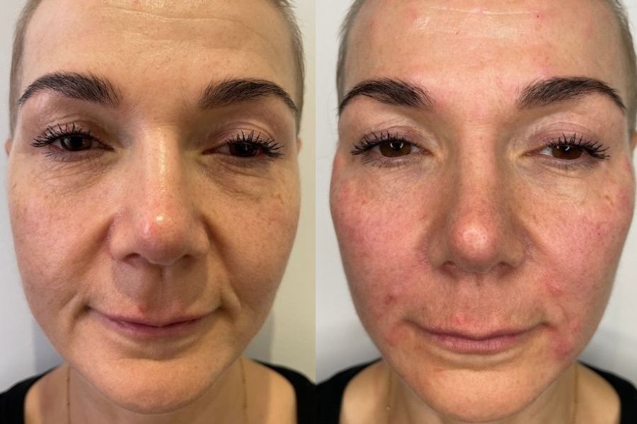 marionette line filler before and after