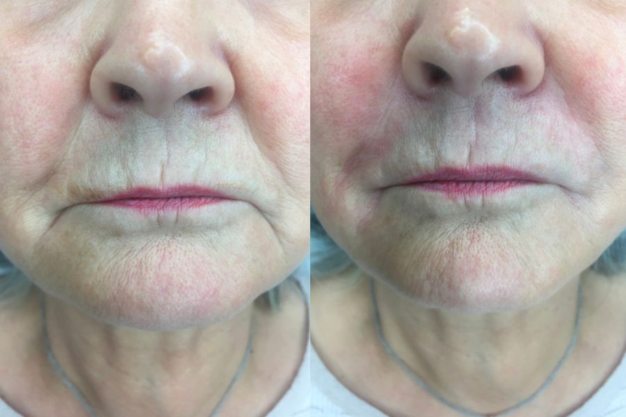 nasolabial and marionette line filler before and after