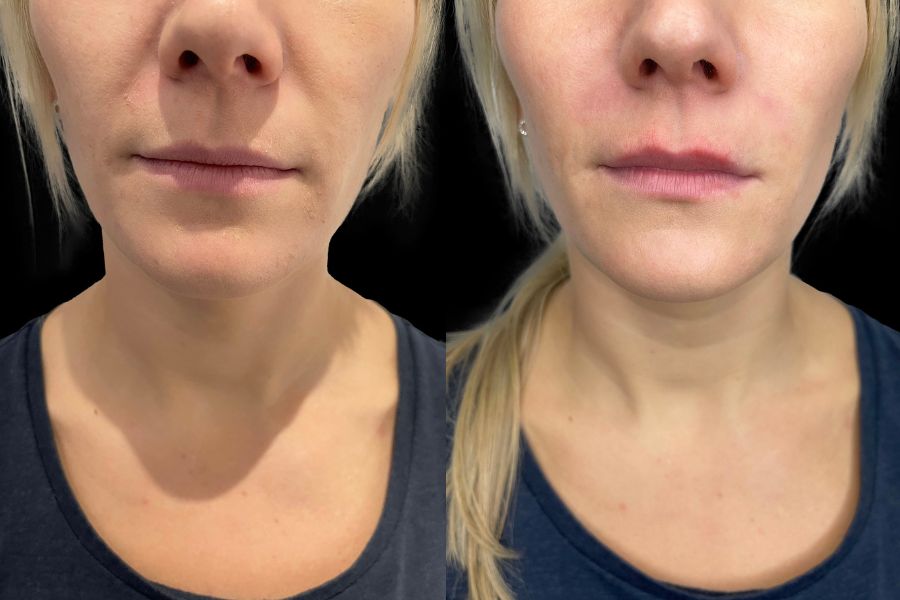 nasolabial line filler before and after