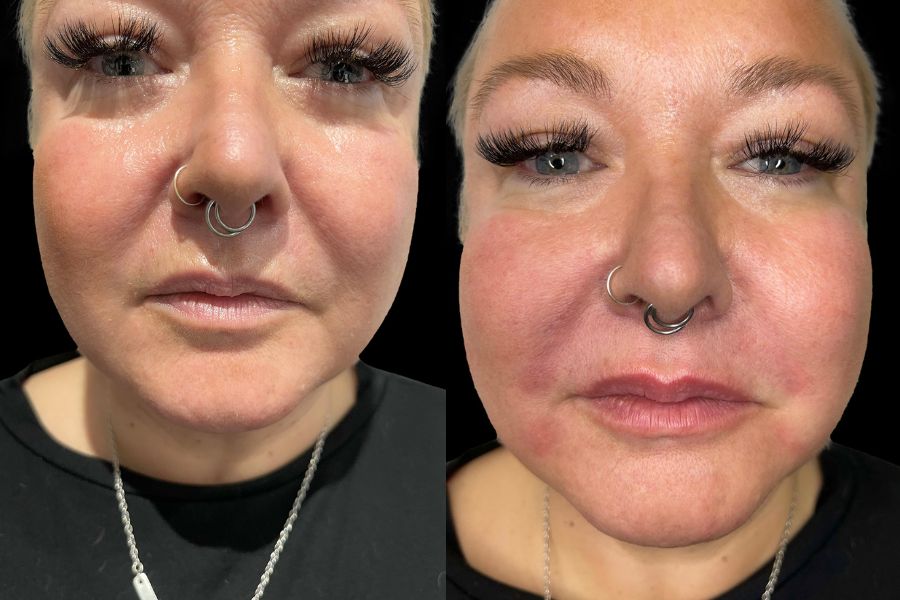 nasolabial line filler before and after