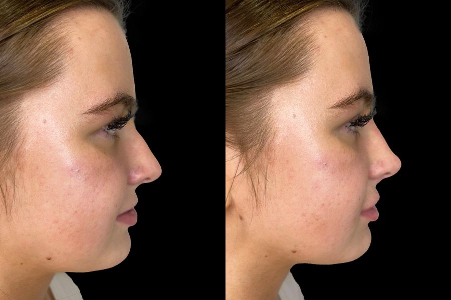 nose filler before and after