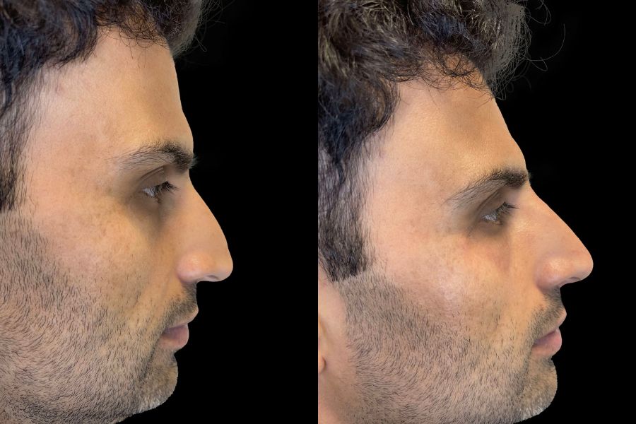 nose filler before and after