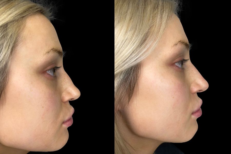 nose filler before and after
