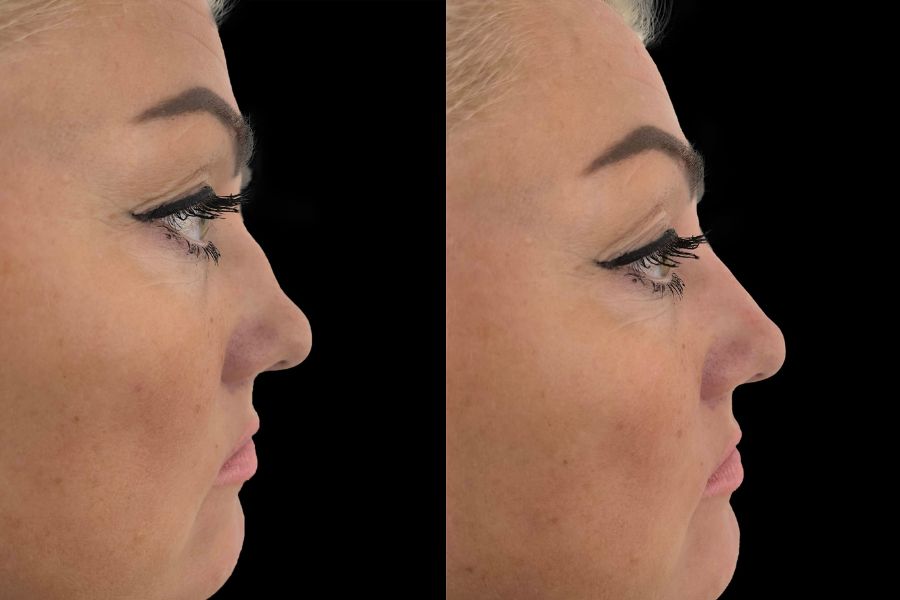nose filler before and after