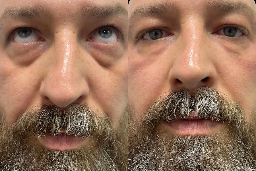 tear trough filler before and after