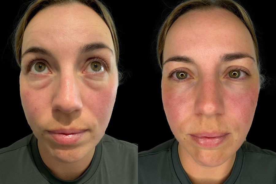 tear trough filler before and after