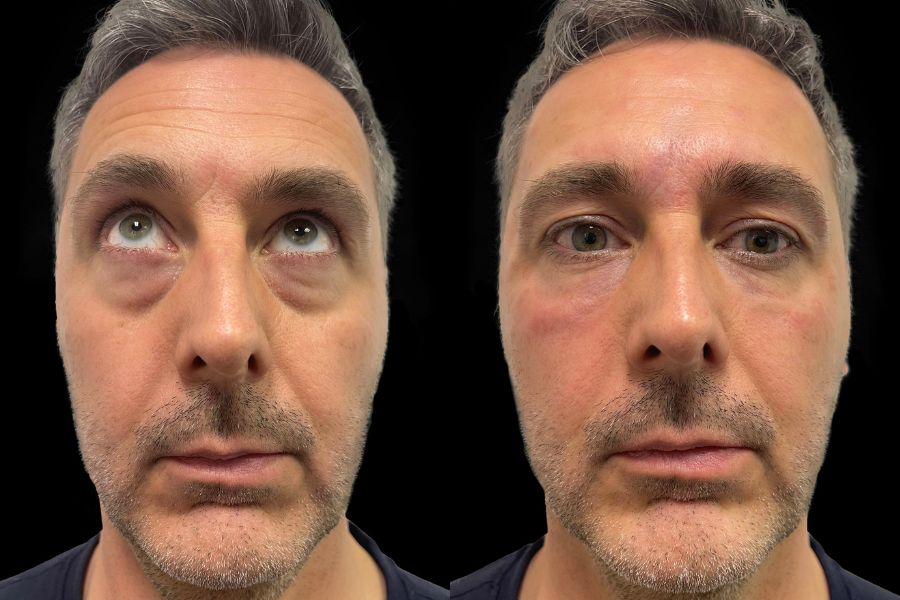 tear trough filler before and after