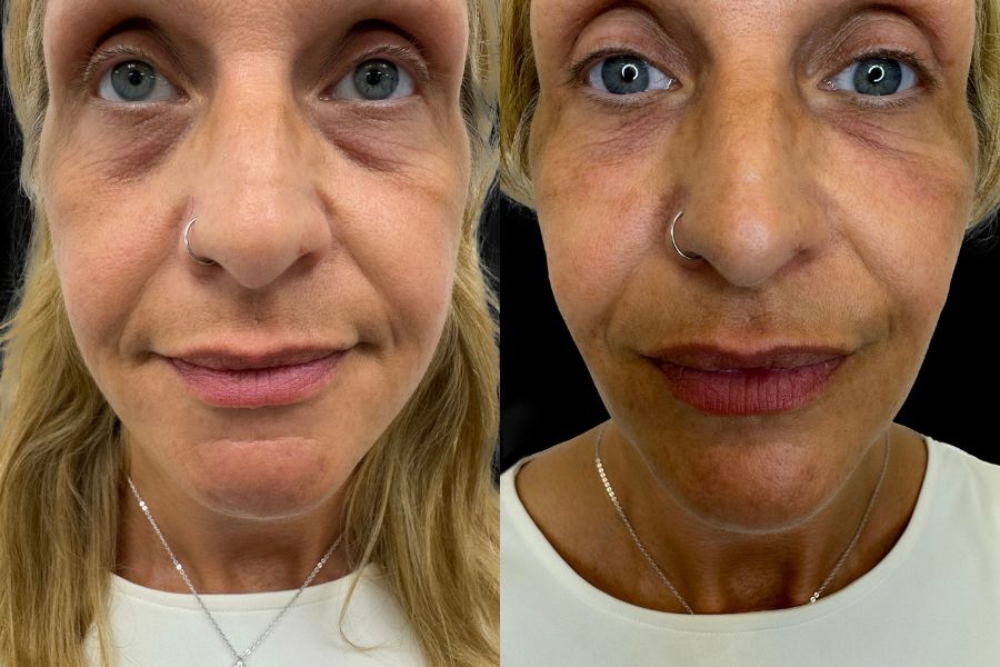tear trough filler before and after