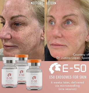 Exosomes before & after