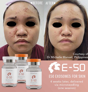 Exosomes before & after