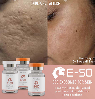 Exosomes before & after