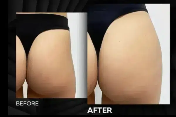 Body Fillers Before and After