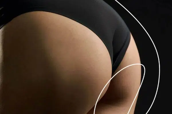 Body Fillers Before and After